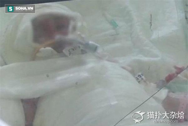 Được mẹ tắm cho bằng vòi hoa sen, bé gái bỏng toàn thân nguy kịch - Ảnh 5.