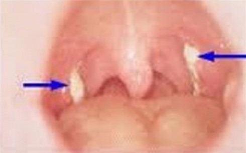 nhung bien chung chet nguoi khi bi benh bach hau hinh 0