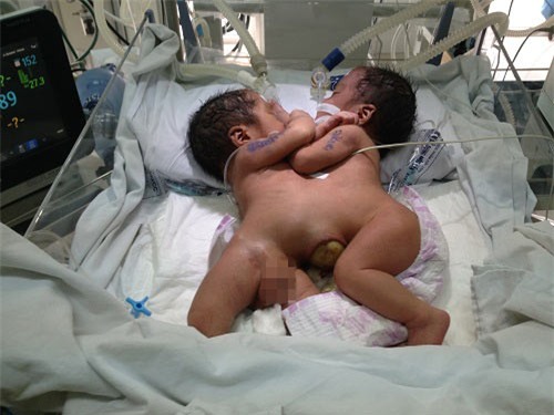 bo cua 2 be so sinh dinh lien: 'toi run ban nguoi khi thay hai con bi dinh nguc, bung' - 1