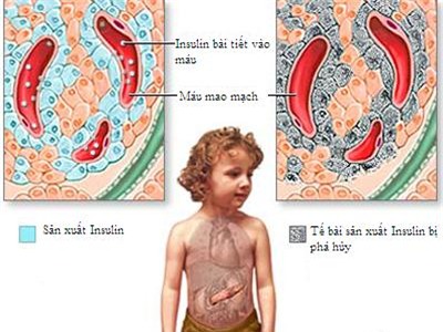 Tiểu đường: Bệnh hiểm đã tấn công cả trẻ em - Ảnh 1.