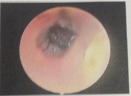 Hình ảnh nội soi có ruồi trong tai phải nạn nhân 