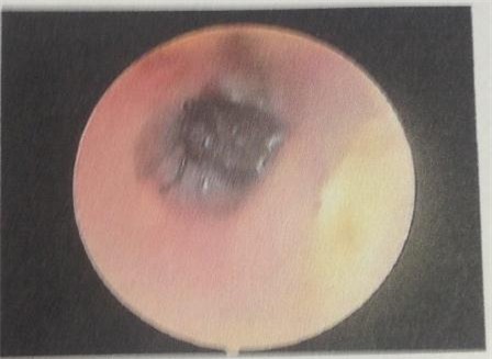 Hình ảnh nội soi có ruồi trong tai phải nạn nhân