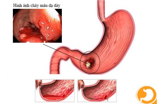 Cảnh báo: Trẻ xuất huyết dạ dày, suýt tử vong vì ăn đồ lạnh - Ảnh 2.