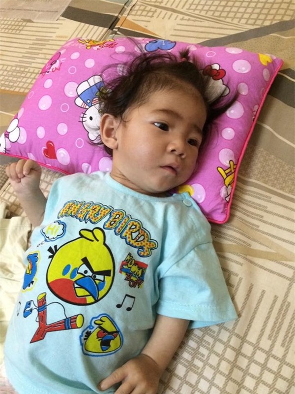Bé gái 14 tháng tuổi nặng 3,5kg đang tập kích thích cơ và đã tăng lên 6,5kg