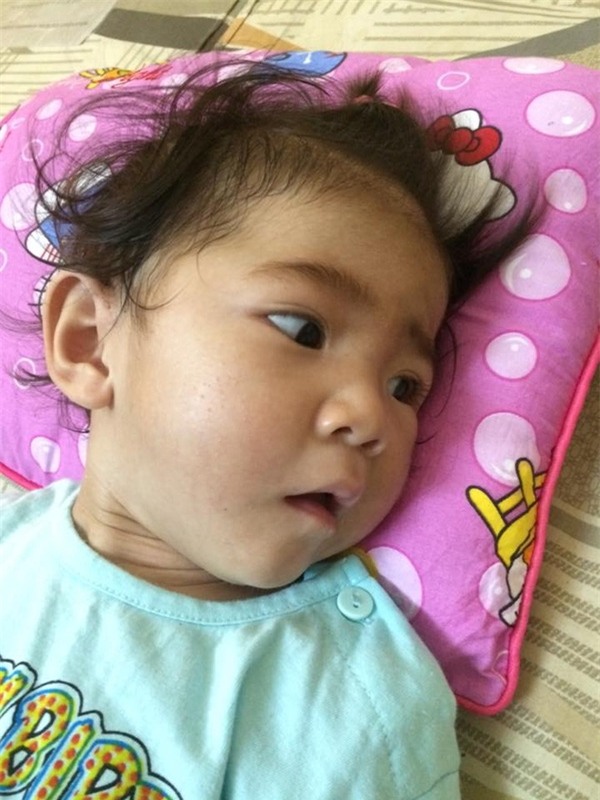 Bé gái 14 tháng tuổi nặng 3,5kg đang tập kích thích cơ và đã tăng lên 6,5kg
