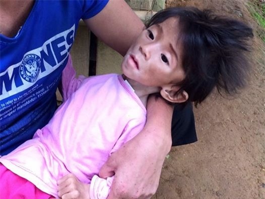 Bé gái 14 tháng tuổi nặng 3,5kg đang tập kích thích cơ và đã tăng lên 6,5kg