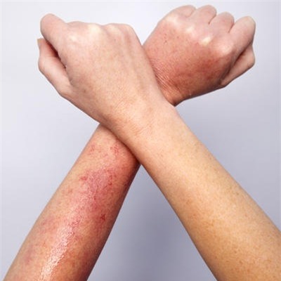 Điểm danh những bệnh ngoài da thường gặp vào mùa hè và cách xử lý