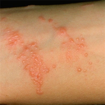 Điểm danh những bệnh ngoài da thường gặp vào mùa hè và cách xử lý