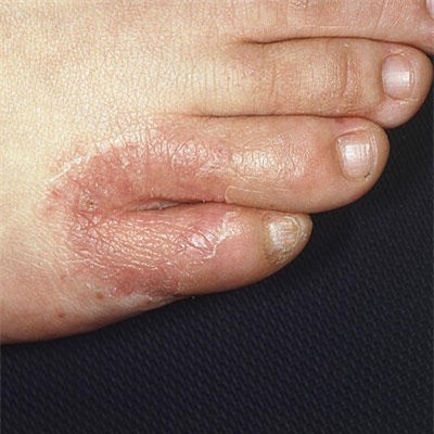 Loạt bệnh ngoài da thường gặp vào mùa hè và cách xử lý