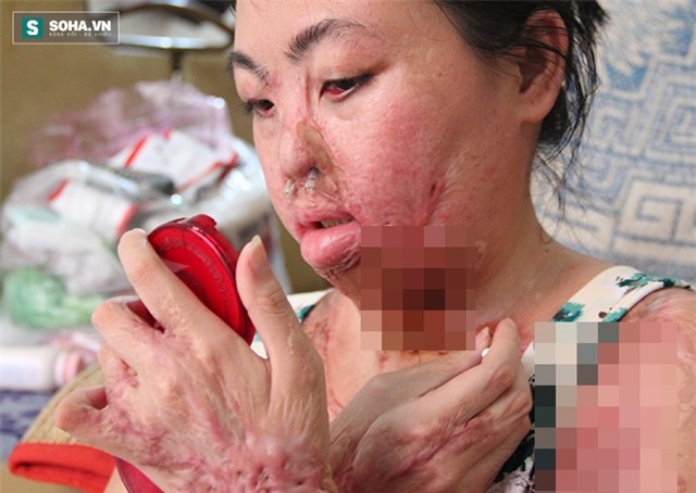 Vừa bị tạt axit lên người, tôi chỉ có cảm giác nóng tột độ... - Ảnh 2.