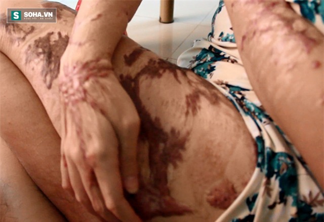 Vừa bị tạt axit lên người, tôi chỉ có cảm giác nóng tột độ... - Ảnh 4.