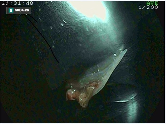 Cảnh báo: Tử vong chỉ vì hóc xương mà chủ quan không chữa trị sớm - Ảnh 2.