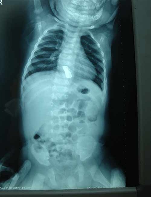 Cảnh báo: Tử vong chỉ vì hóc xương mà chủ quan không chữa trị sớm - Ảnh 3.