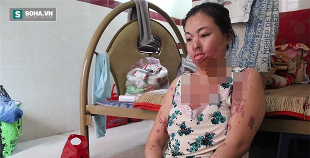 “Người mẹ ma” ở TP HCM: 'Ước gì tôi biết vì sao mình bị tạt axit'