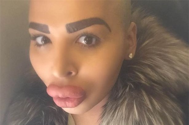 Kim Kardashian, phẫu thuật thẩm mỹ, bơm môi,