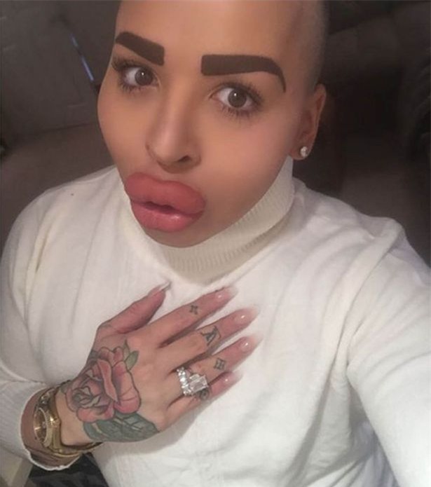 Kim Kardashian, phẫu thuật thẩm mỹ, bơm môi,