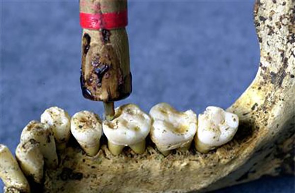 Răng tự phát nổ trong miệng? Câu chuyện có thật ở thế kỷ 19 - Ảnh 5.