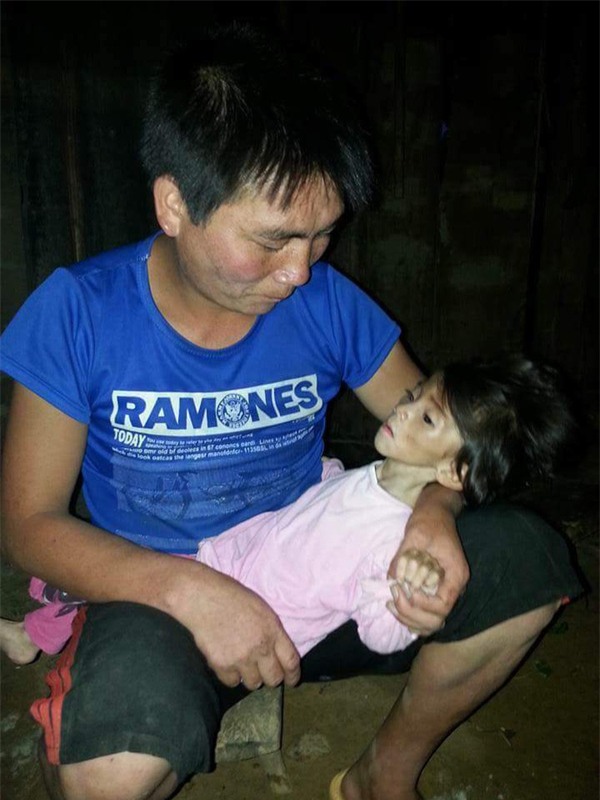 Hành trình kỳ diệu thay da đổi thịt của bé gái 14 tháng tuổi chỉ nặng 3,5kg