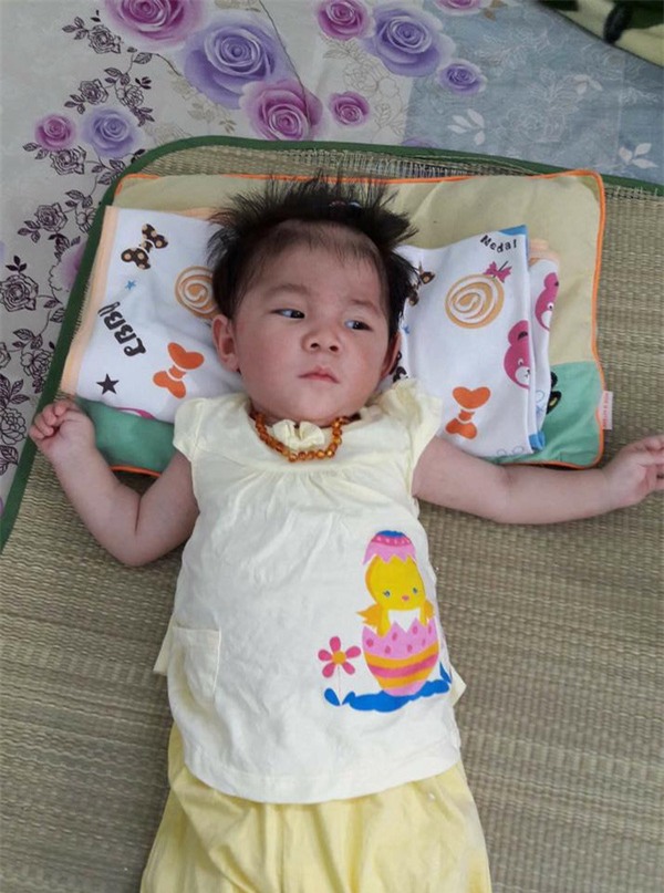 Hành trình kỳ diệu thay da đổi thịt của bé gái 14 tháng tuổi chỉ nặng 3,5kg