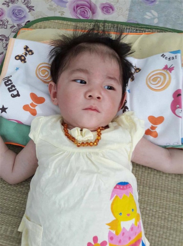 Hành trình kỳ diệu thay da đổi thịt của bé gái 14 tháng tuổi chỉ nặng 3,5kg