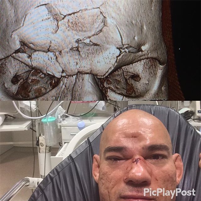 Võ sĩ MMA bị đá vỡ sọ thoát khỏi lưỡi hái tử thần - Ảnh 4.