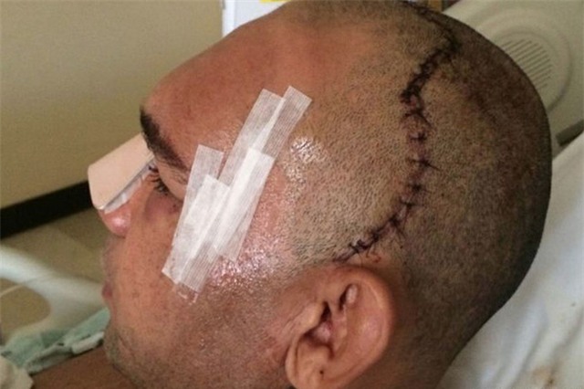 Võ sĩ MMA bị đá vỡ sọ thoát khỏi lưỡi hái tử thần - Ảnh 5.
