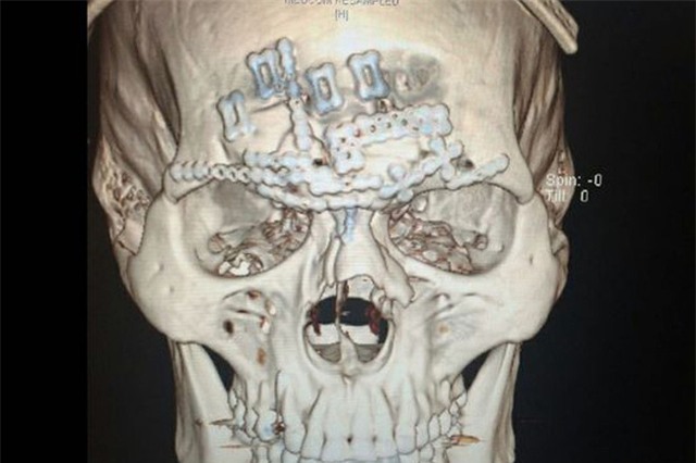 Võ sĩ MMA bị đá vỡ sọ thoát khỏi lưỡi hái tử thần - Ảnh 6.