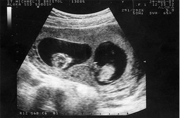 Siêu âm thai đôi nhưng cả bác sĩ và gia đình sốc khi sinh con ra lại thế này - Ảnh 1.