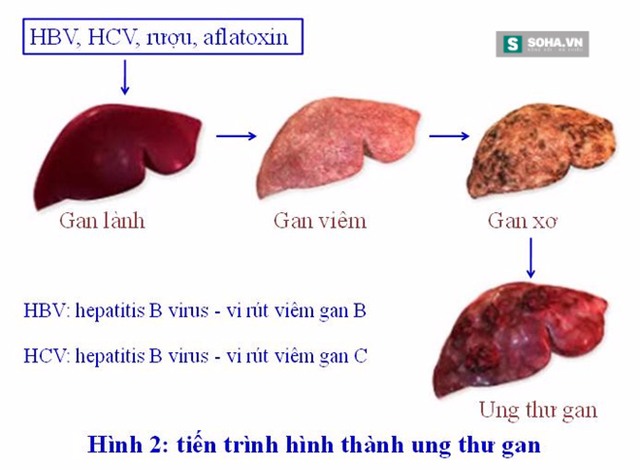 Từ viêm gan đến ung thư: Chỉ mất 3 bước - Ảnh 3.