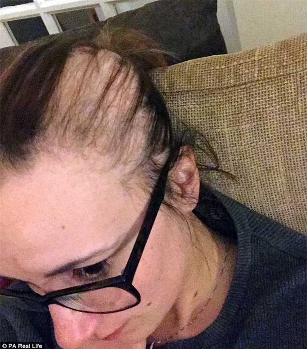 rụng tóc, trụi tóc, thi cử, căng thẳng, sức ép, nữ sinh