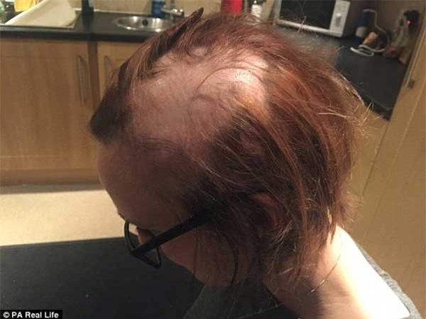 rụng tóc, trụi tóc, thi cử, căng thẳng, sức ép, nữ sinh