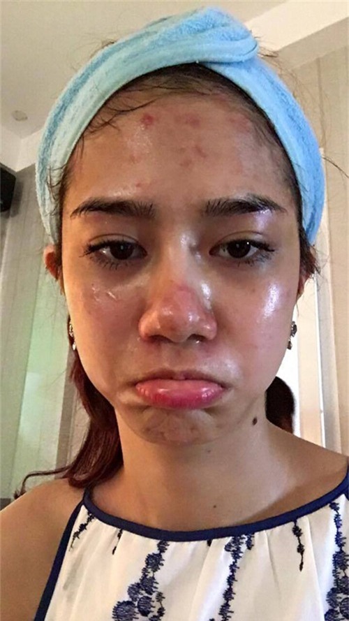 Sau 3 lần lăn kim, da của Ngọc Bích mẩn đỏ, sưng, mụn xuất hiện nhiều.