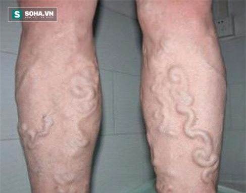 4 dấu hiệu của bệnh suy tĩnh mạch cần đi khám ngay - Ảnh 1.