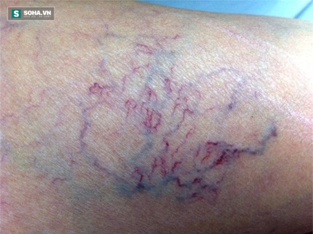 4 dấu hiệu của bệnh suy tĩnh mạch cần đi khám ngay - Ảnh 2.