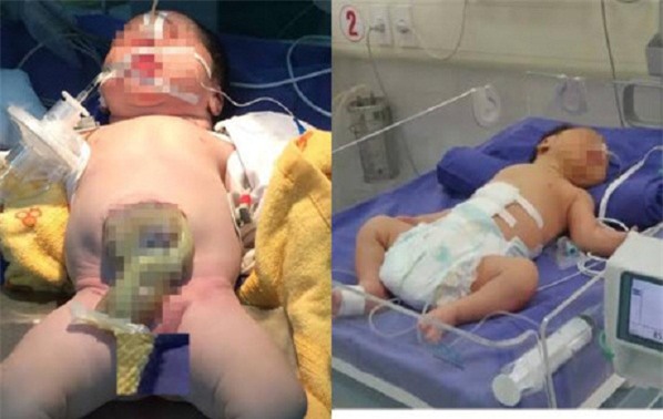 Cứu sống bé sơ sinh 1 giờ tuổi lộ nội tạng ra ngoài thành bụng