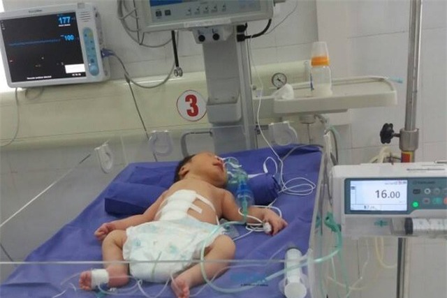Cứu sống bé sơ sinh 1 giờ tuổi lộ nội tạng ra ngoài thành bụng