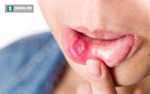 Vết lở loét ở miệng: Dấu hiệu của một số căn bệnh nguy hiểm - Ảnh 1.