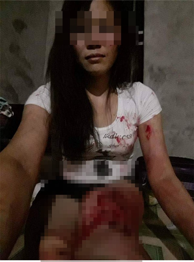 Bị chồng đánh rách thịt, người vợ tự lấy kim khâu vết thương - Ảnh 1.