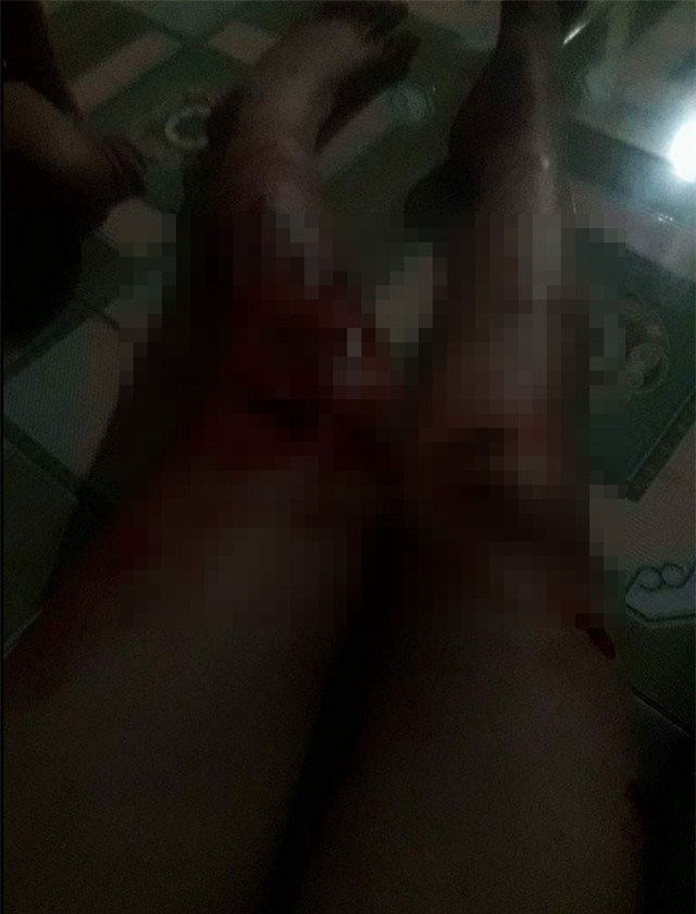 Bị chồng đánh rách thịt, người vợ tự lấy kim khâu vết thương - Ảnh 2.