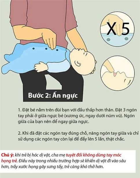 xử lý khi trẻ bị hóc nghẹn 3