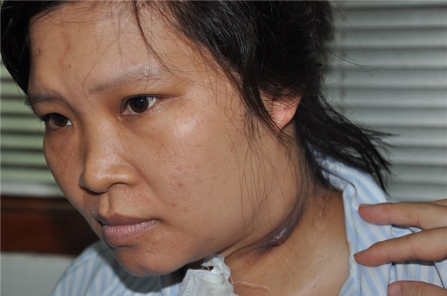 Chị phát hiện cùng lúc 2 bệnh, Lơ xê mi cấp và Thalassaemia nhưng vì có nhọt ở cổ nên chưa thể truyền hóa chất ngay.