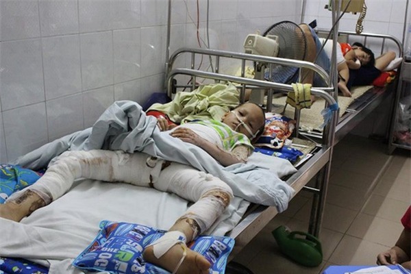 Cô nướng mực, ba cháu thành ngọn đuốc