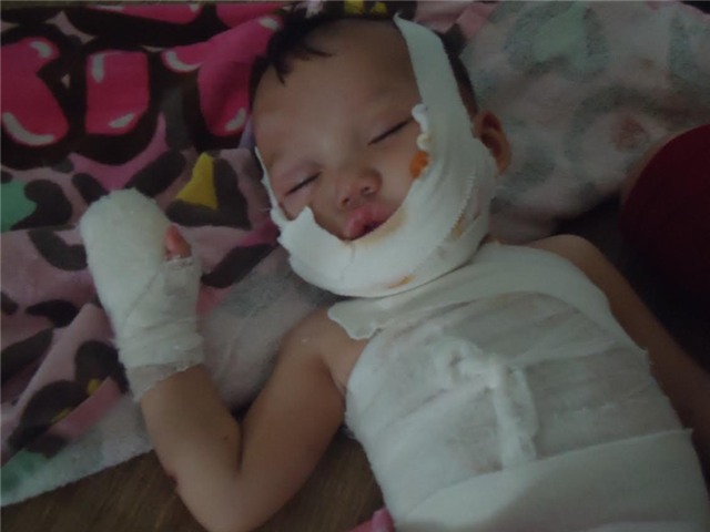 hoàn cảnh khó khăn, bệnh hiểm nghèo, viện bỏng quốc gia