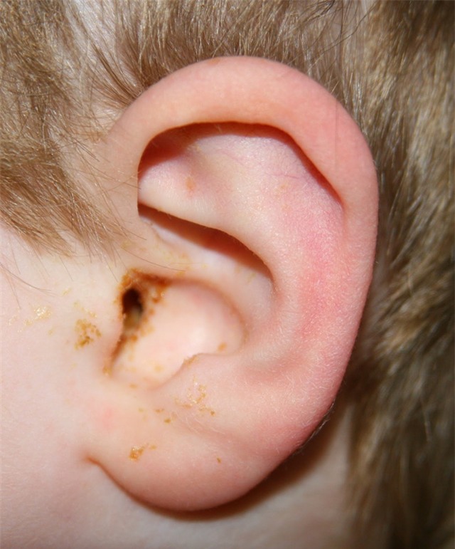 Muối + 1 chiếc tất: Trị hiệu quả viêm tai, nhiễm trùng tai cho trẻ - Ảnh 1.