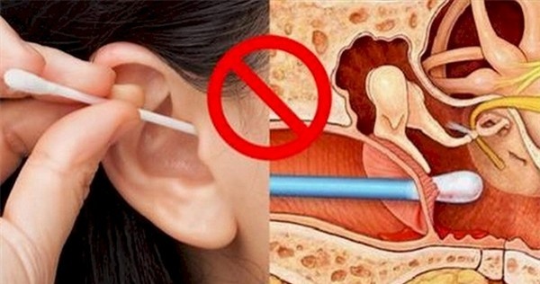 Con bị rách màng nhĩ vì mẹ dùng tăm bông lấy ráy tai cho con - Ảnh 2.