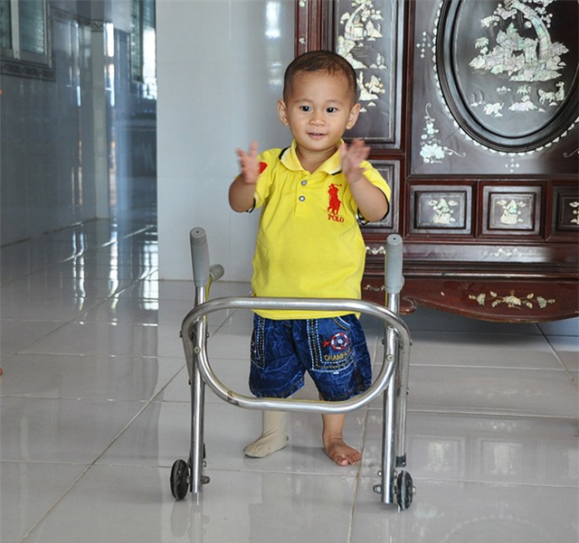 Bé bị văng khỏi bụng mẹ kháu khỉnh đón Tết với chân giả