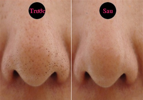 nguyen lieu don gian diet mun cam, mun dau den xau xi noi canh mui - 6