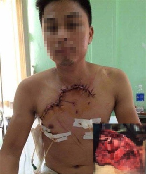 tai nạn hy hữu, lộ tim phổi, bệnh viện Việt Đức