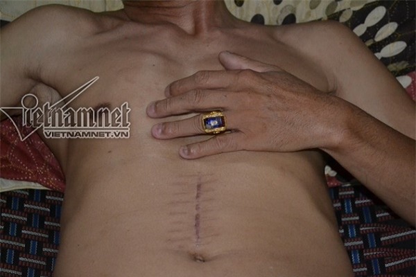 GS Hà Văn Quyết, u trực tràng, mở bụng nhưng không cắt u