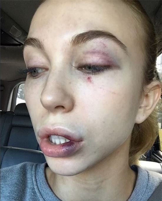 Elise Chambellant, hoa hậu, hoa hậu hoàn vũ, hoa hậu hoàn vũ Úc, miss universe, chung kết, đánh hội đồng, thí sinh hoa hậu, dã man